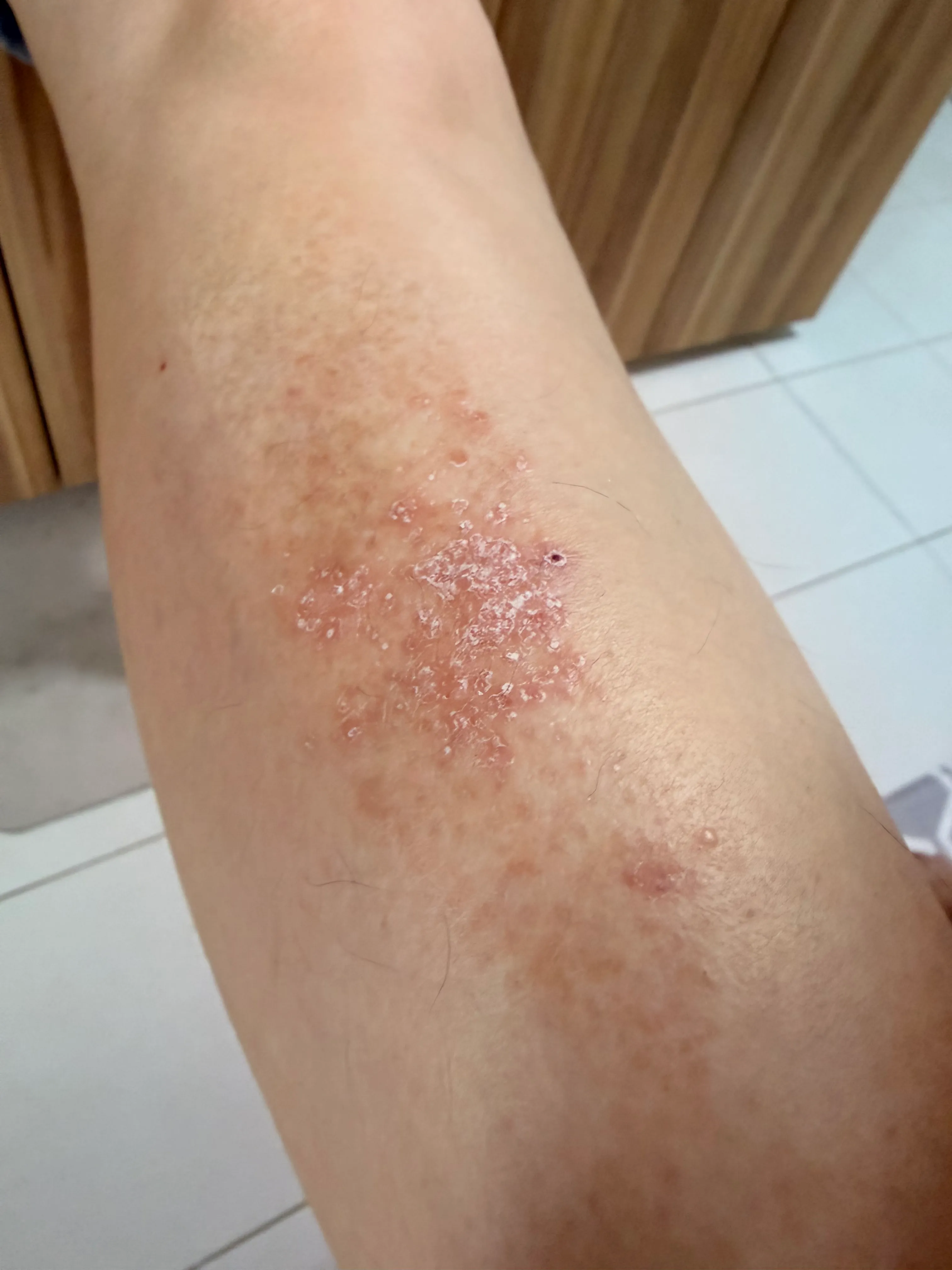 An inflamed, flaking patch of eczema on a lower leg
